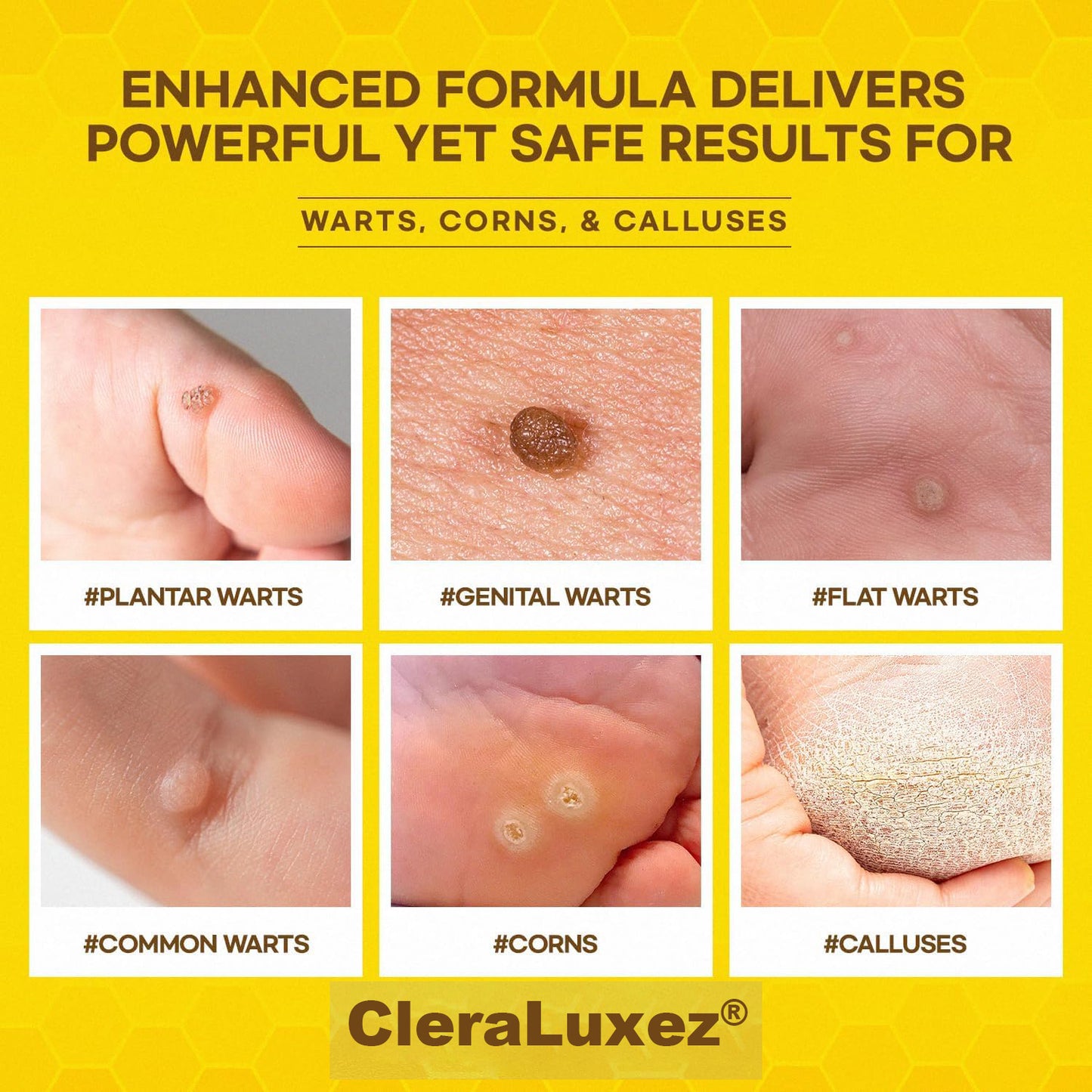⚡Fast-Acting bee Venom Wart Remover: CleraLuxe® Bee venom skin repair agent（✅️Results visible in 7 days.）