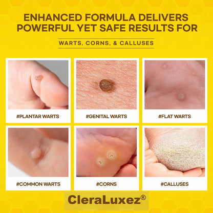⚡Fast-Acting bee Venom Wart Remover: CleraLuxe® Bee venom skin repair agent（✅️Results visible in 7 days.）