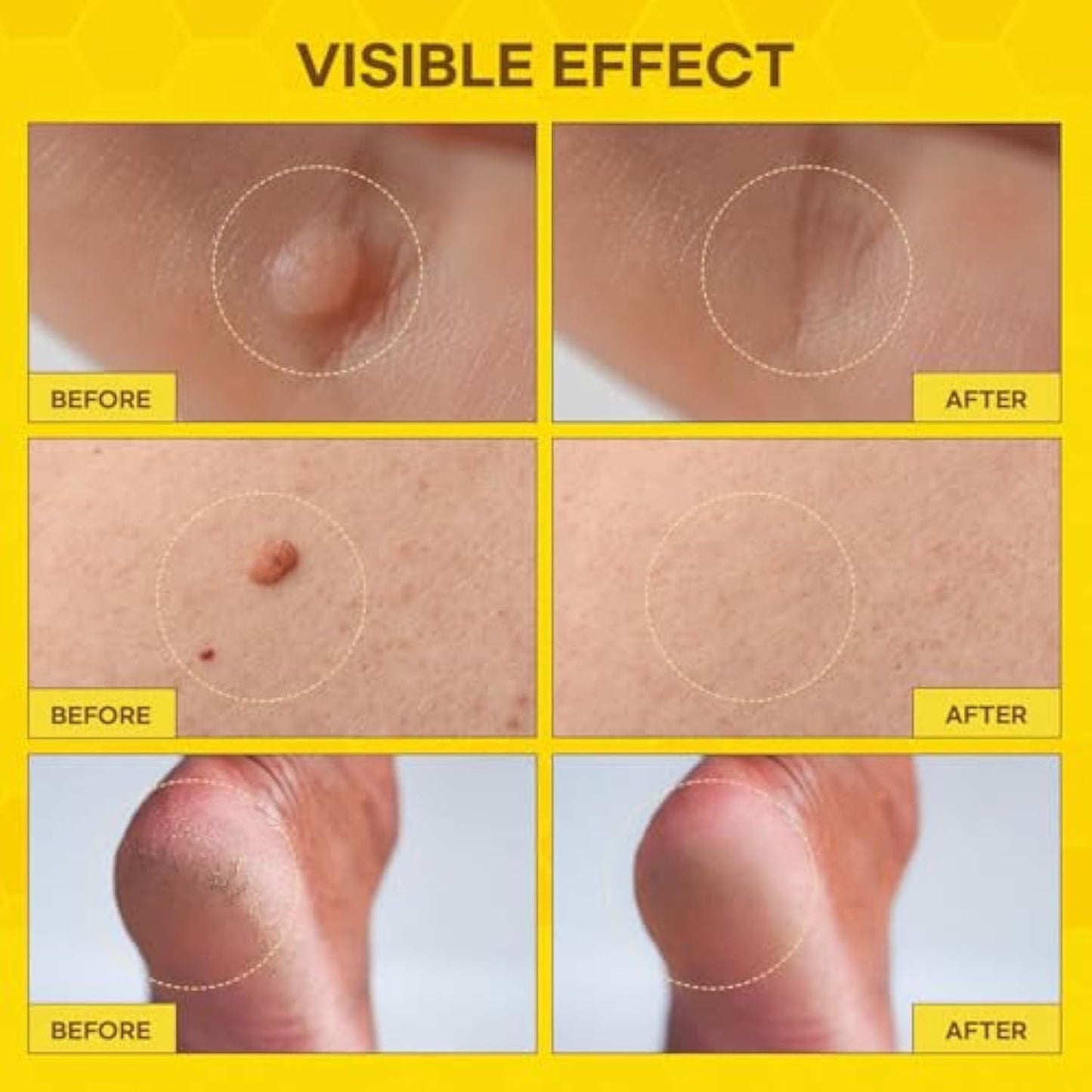 ⚡Fast-Acting bee Venom Wart Remover: CleraLuxe® Bee venom skin repair agent（✅️Results visible in 7 days.）